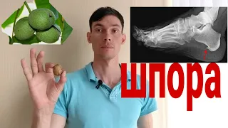 Пяточная ШПОРА убрать легко