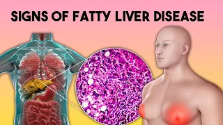 A Silent Threat: 8 Signs of Fatty Liver Disease