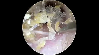 SATISFYING VIDEOS OF EAR WAX REMOVAL #112🧐