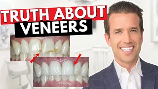 Before you get Dental Veneers Watch This! | Are Veneers Worth It?