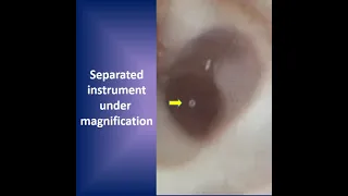 Bypassing a separated instrument in a root canal