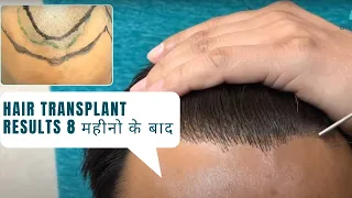 Hair Transplant Results after 8 months | Hair Transplant Before & After Results | Dr Jangid