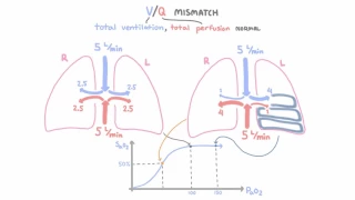 V-Q mismatch