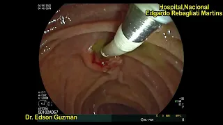 BASICS IN ERCP: Acute cholangitis diagnosing during ERCP