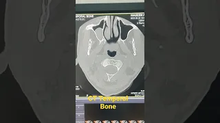 CT Temporal Bone | Discharge pus from rt ear cavity| Mucus retention cyst in rt maxillary sinus