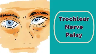 Trochlear Nerve Palsy Rapid Review