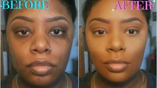 How To: Color Correct/Conceal Dark Circles, Acne Scars, & Birthmarks (For Dark Skin)