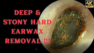DEEP & Stony HARD Earwax Removal (Very Satisfying Video)