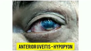 ANTERIOR UVEITIS WITH HYPOPYON