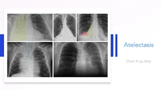 Atelectasis: Chest X-ray Atlas