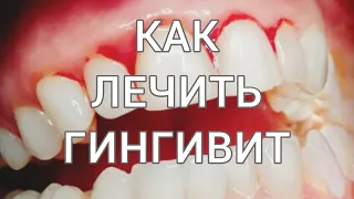 Кровоточит ДЕСНА. Кровоточивость десен. КАК ЛЕЧИТЬ десна при гингивите?