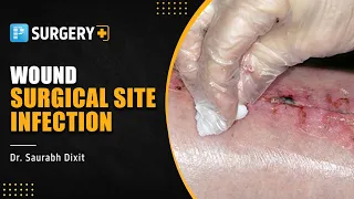 Wound - Surgical Site Infection | Surgery by Dr. Saurabh Dixit | PrepLadder NEET-SS