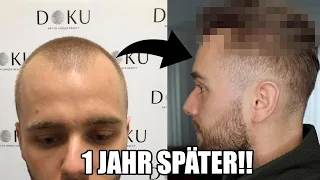 Haartransplantation Türkei – Vorher Nachher | 1 Jahr Update