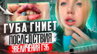 ГУБА ГНИ*Т! ПОСЛЕДСТВИЯ УВЕЛИЧЕНИЯ ГУБ. Я ПРИНЯЛА РЕШЕНИЕ...