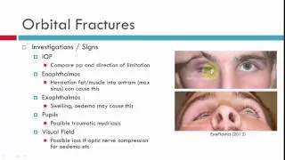 Blow Out Fractures Chatacteristics