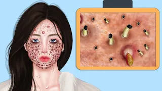 ASMR Giant Acne & Black Head Pimple Removal - Acne Deep Cleaning Animation