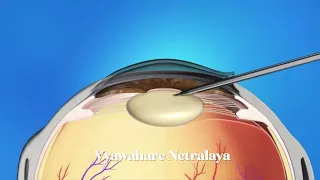 Animated Cataract Surgery Video by Phacoemulsification