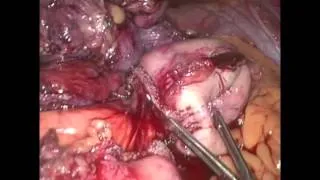 Laparoscopic Revision of Revision of Roux-en-Y Gastric Bypass