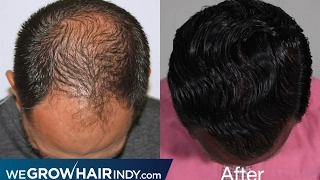 Max Density with One Hair Transplant - Will Testimonial