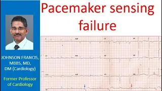 Pacemaker sensing failure