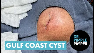 Dr Pimple Popper Opens The 'Gulf Coast' Cyst