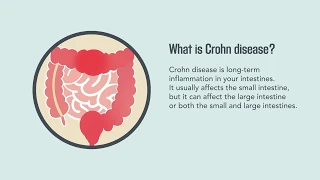 Crohn Disease: Signs, Symptoms, Causes, and Treatment | Merck Manual Consumer Version