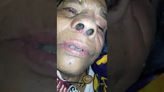 Nasal maggots in diabetic