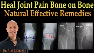 Heal Joint Pain Bone on Bone - Dr. Alan Mandell, D.C.