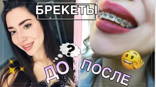 БРЕКЕТЫ МОЯ ИСТОРИЯ / КАКИЕ ЗУБЫ У МЕНЯ БЫЛИ ДО БРЕКЕТОВ???😱