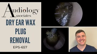 DRY EAR WAX PLUG REMOVAL - EP657