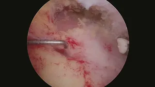 Superior Rotator Cuff Arthroscopic Anatomy - A Quick Clip Demonstrating the Insertion Sites