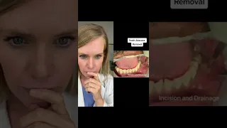 Tooth abscess removal. #infection #toothabscess #dentist #abscess