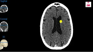 Ct brain (01) || normal anatomy ventricles & subarachnoid cisterns