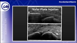 Volar plate injuries in the fingers