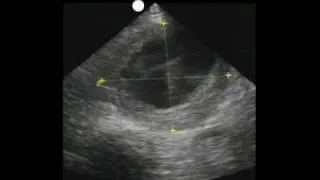How to: Aorta Ultrasound - Aneurysms Case Study