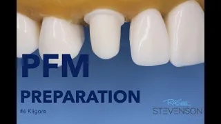 PFM Preparation on The Canine Tooth #6 Kilgore | Stevenson Dental Solutions