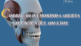 Correção da MORDIDA ABERTA em pacientes adultos - Prof. Dr. Pedro Andrade Jr.