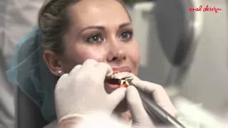 Nuove Faccette Dentali - Natalia racconta la sua storia con Oral Design