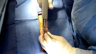 Dr. Baladi's Skin Stapling Technique