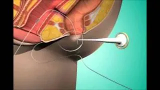 Fistula Treatment in Pune | Fistula Hospital in Pune | Dr. Ashwin Porwal - Fistula Surgeon Pune