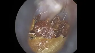 40 - How can the WAXscope®️ help improve your Ear Wax Removal service?