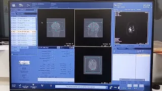 how to do mri perfusion contrast