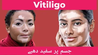 Vitiligo in Urdu/Hindi: Causes, Signs and Symptoms, Diagnosis and Treatment Plan.