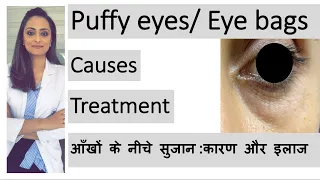 puffy eyes| eye bags|  aankhon ke neeche sujan | कारण और इलाज | Dr. Aanchal | dermatologist