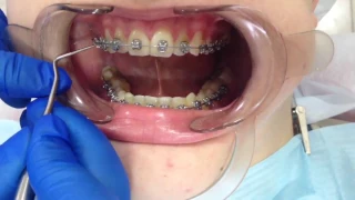 Снятие брекетов и чистка зубов | стоматология Самара | брекеты  влог braces off