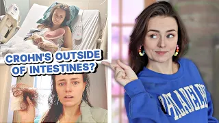 I Didn't Know Crohn's Could Do This! (Symptoms I've Had OUTSIDE of My Intestines) | Let's Talk IBD