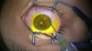 Corneal Collagen Cross Linking for Keratoconus