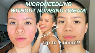 Microneedling my acne scars l Day 1 to 5 healing process