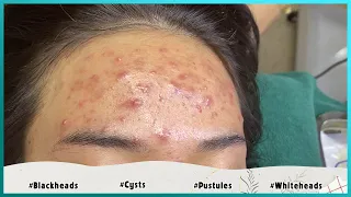 Big Cystic Acne Blackheads Extraction Blackheads & Milia, Whiteheads Removal Pimple Popping