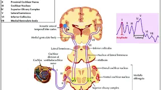 SNHL and Tinnitus